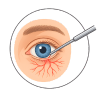Eye Surgery
